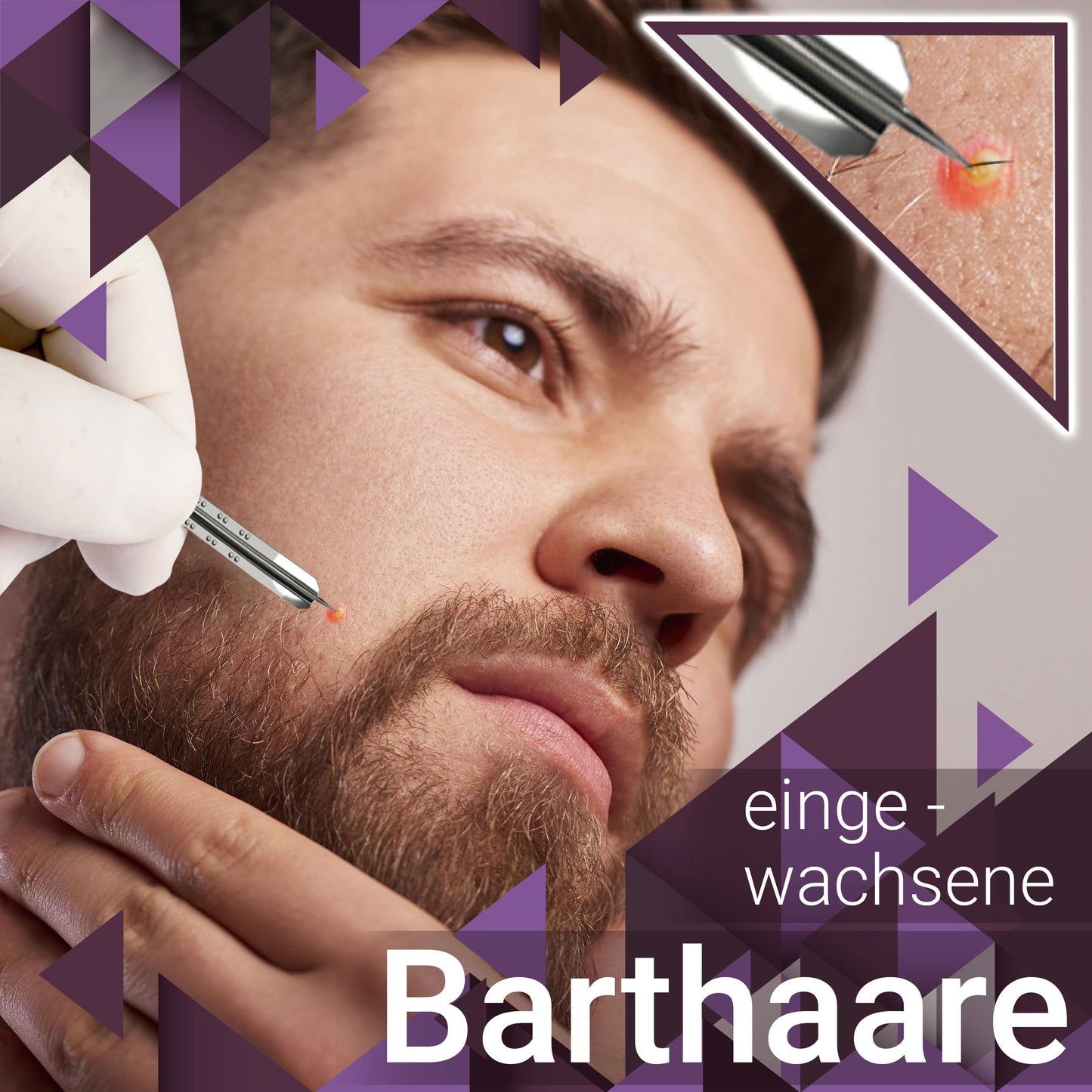 50x Einweglanzette, Kosmetex Milienlanzette, Blutlanzette, sterile Stainless Steel Lanzette
