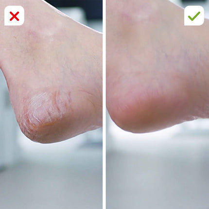 PediVac - electric callus remover - rechargeable - callus planer - callus rasp - foot care - pedicure - 2 attachments [coarse &amp; fine]