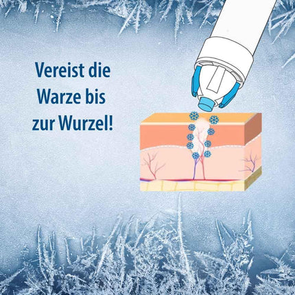 Evolsin® Wart Freezer for common warts &amp; verrucas | Wart freezing hygienic &amp; safe | Wart remedy