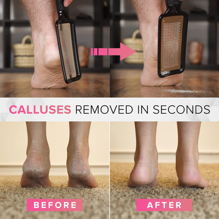 ULTIMATE Callus File Callus Remover For Foot Care (Large) MEGAFILE Callus Planer For Callus Removal Foot - Callus Rasp For Callus Remover Heavy Calluses Dead Skin Foot Scraper