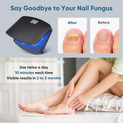 Berrlly nail fungus laser device, upgraded nail fungus laser device, enhanced 910nm infrared + 470nm blue light, height adjustable, can treat multiple nails at once, safe and reliable
