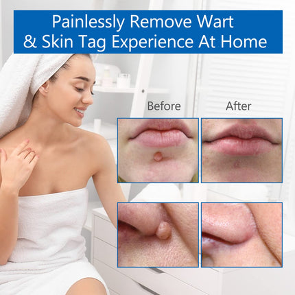 Skin Tag Removal, 2 Sizes Auto Remover Pen Set, Effective, Painless, Easy, and Safe for Small to Large Skin Warts and Moles (1-9 mm). Safe for Most Body and Face Areas