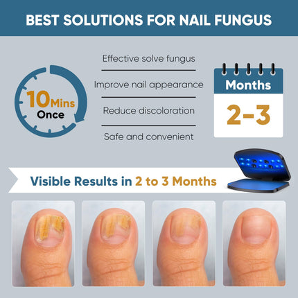Berrlly nail fungus laser device, upgraded nail fungus laser device, enhanced 910nm infrared + 470nm blue light, height adjustable, can treat multiple nails at once, safe and reliable