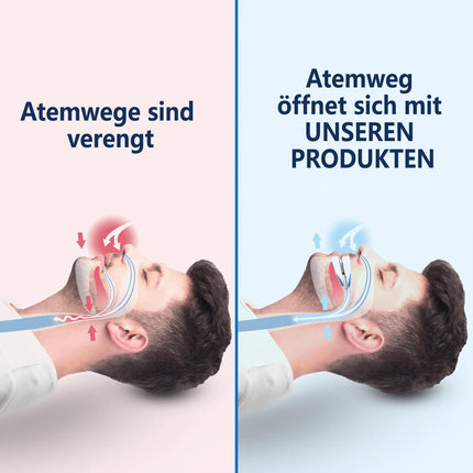 Dabeto Snoring &amp; Protrusion Device, Anti Snoring, Snoring Stopper, Anti Snoring Device Snoring Device (A)