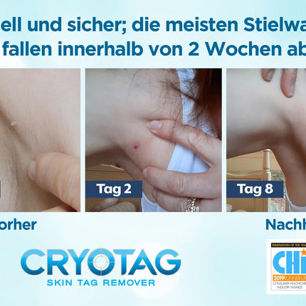 Cryotag Skin Tag Remover - Fast Acting Safe - Clinically proven freezing agent for the treatment of skin tag warts, up to 12 applications