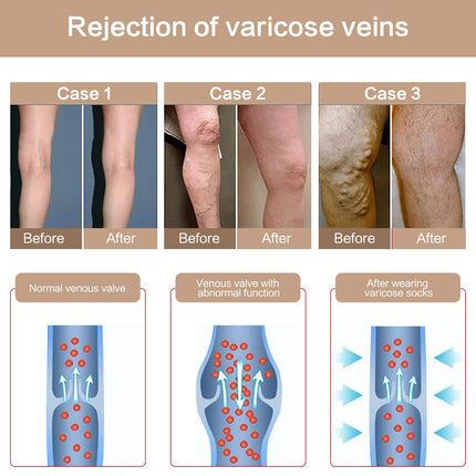 YISEMEYA 2 Pairs Medical Compression Stockings Women Long, 20-30 mmHg Support Stockings Women, Opaque Toe Wrap Compression Tights Women, Great Support for Varicose Veins, Edema