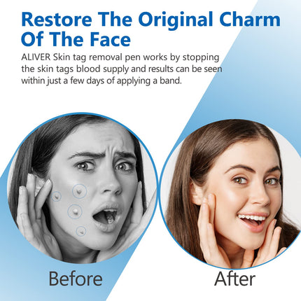 Skin Tag Removal, 2 Sizes Auto Remover Pen Set, Effective, Painless, Easy, and Safe for Small to Large Skin Warts and Moles (1-9 mm). Safe for Most Body and Face Areas
