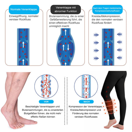 YISEMEYA 2 Pairs of Medical Compression Stockings for Women &amp; Men 20–30 mmHg, Progressive Support Tights, Opaque Toeless Compression Tights Class 2, Suitable for Varicose Vein Edema, DVT (XXL)