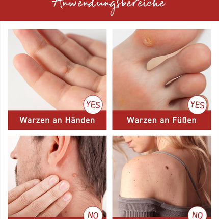 N1 Wart Tincture 2ml - Effective Wart Remover [Medical Device] - Easy to use &amp; painless - Only once a week - Ideal wart remedy for pedunculated, verrucas &amp; common warts